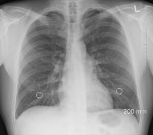 Rentgenový snímek hrudníku